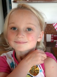 Lara with first mossie bites - she got 17 in one night