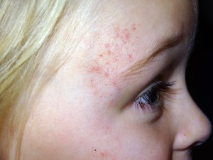 Lara Monkey Bar Face Scrape